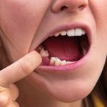 What Are the Options for Replacing Missing Teeth